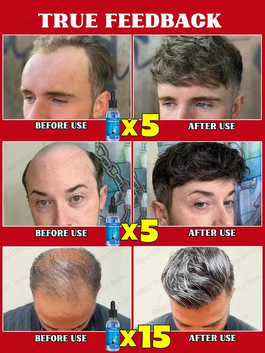 WPRBREGT Blaue Flasche Haarausfall-Wachstumsessenz Öl. Sag Lebewohl zu Haarausfall. Das Geheimnis für dickes Haar, Haarwachstumsserum